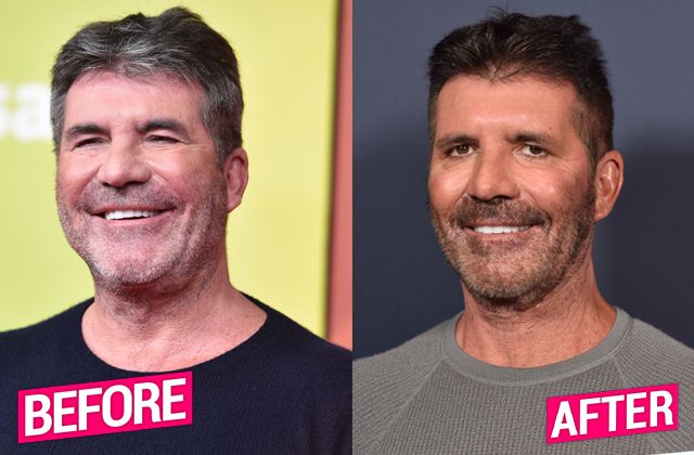 Men are also impacted by toxic beauty standards. Simon Cowell before and after Botox and fillers. 