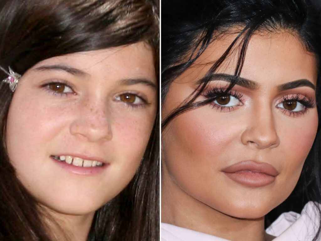 Kylie Jenner before and after lip fillers. 